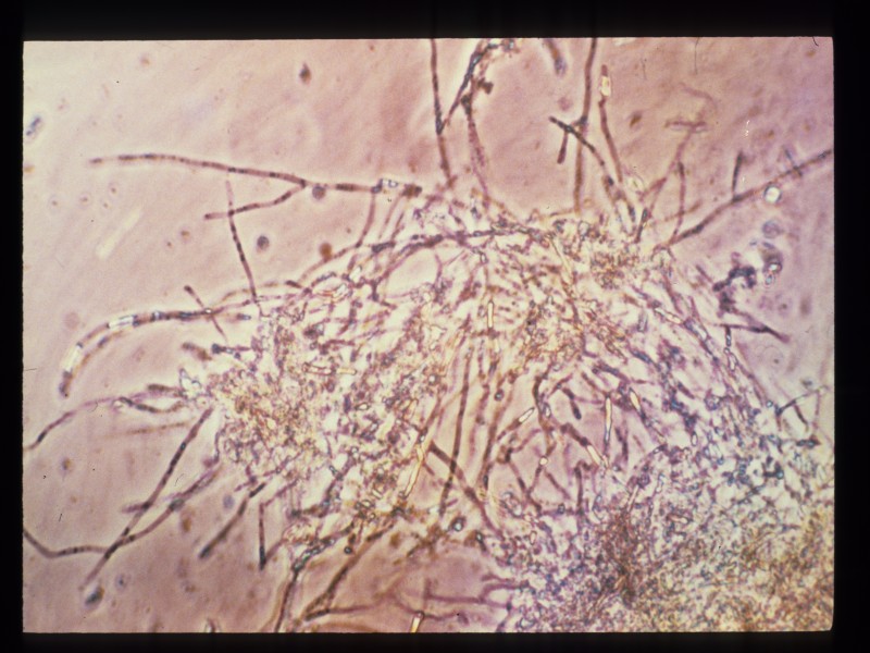 Обнаружены споры и мицелий. Грибы кандида микроскопия. Мицелий и псевдомицелий. Candida albicans микроскопия.