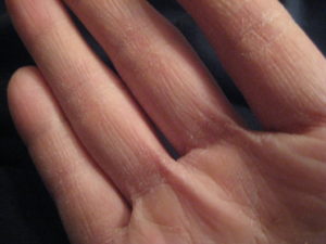 Симптомы грибка между пальцами рук