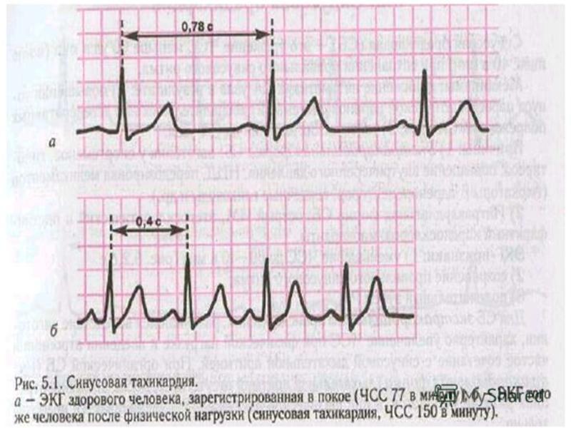 Экг синусовый ритм что это. Синусовая тахикардия на ЭКГ. Показатель синусовой аритмии в ЭКГ. ЭКГ при синусовой тахикардии. ЭКГ при синусовой аритмии.