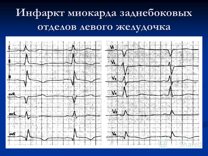 Изменение левого желудочка. ЭКГ при боковом инфаркте миокарда. Заднебоковой инфаркт на ЭКГ. ЭКГ при заднебоковом инфаркте миокарда. Задний боковой инфаркт миокарда ЭКГ.