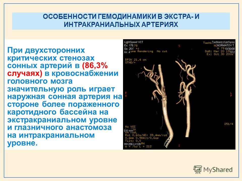 Атеросклероз интракраниального отдела. Кт ангиография тромбоз интракраниальных артерий. Стеноз сонной артерии ангиограмма. Экстра и интракраниальные отделы артерий головного мозга. Интарктариальные артерии.