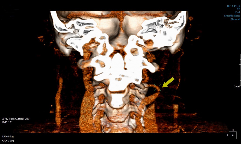 Гипоплазия левой позвоночной артерии симптомы. Аномалия позвоночной артерии с 4. Гипоплазия правой позвоночной артерии.