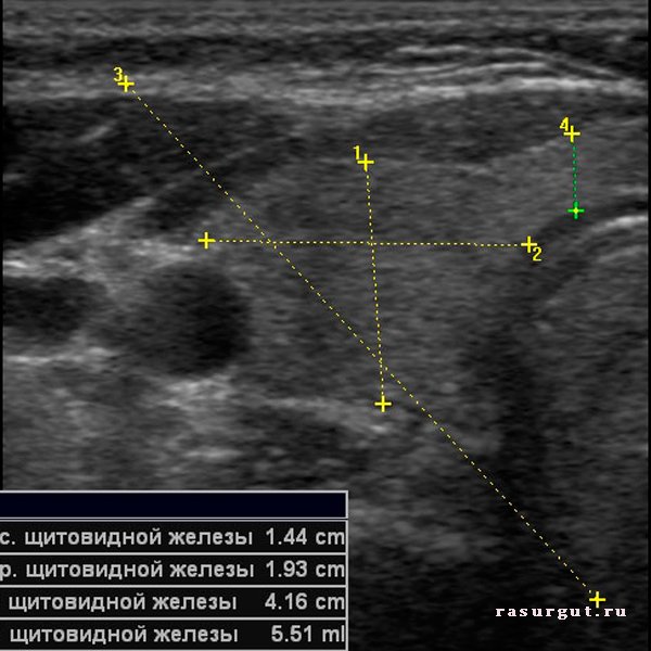 Диффузный токсический зоб узи картина