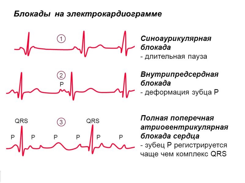 Блокады сердца на ЭКГ