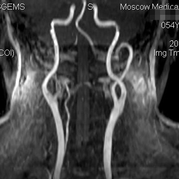 Асимметрия интракраниальных позвоночных артерий