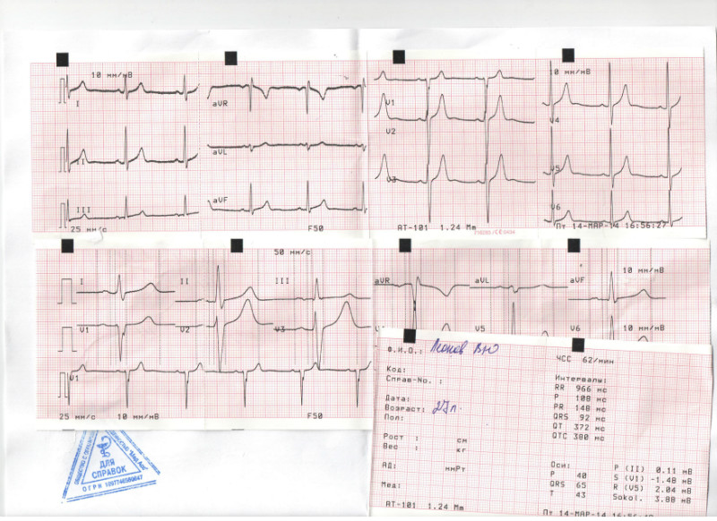 Кардиограмма расшифровка