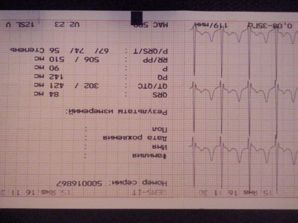 Экг расшифровка. Норма показаний кардиограммы сердца. Кардиограмма сердца расшифровка норма. Расшифровка ЭКГ сердца у взрослого. Норма ЭКГ У взрослых.