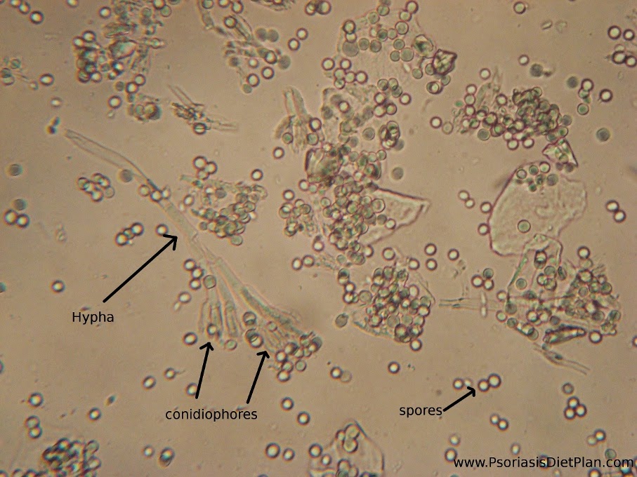 Споры candida. Грибы кандида микроскопия. Дрожжи Candida под микроскопом. Дрожжи Cryptococcus terricolus. Дрожжевые грибы микроскопия мочи.