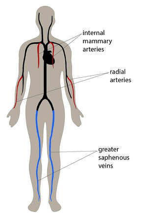 Illustrated diagram showing the location of internal mammary arteries in the chest, radial arteries in the forearms and greater saphenous veins in the legs