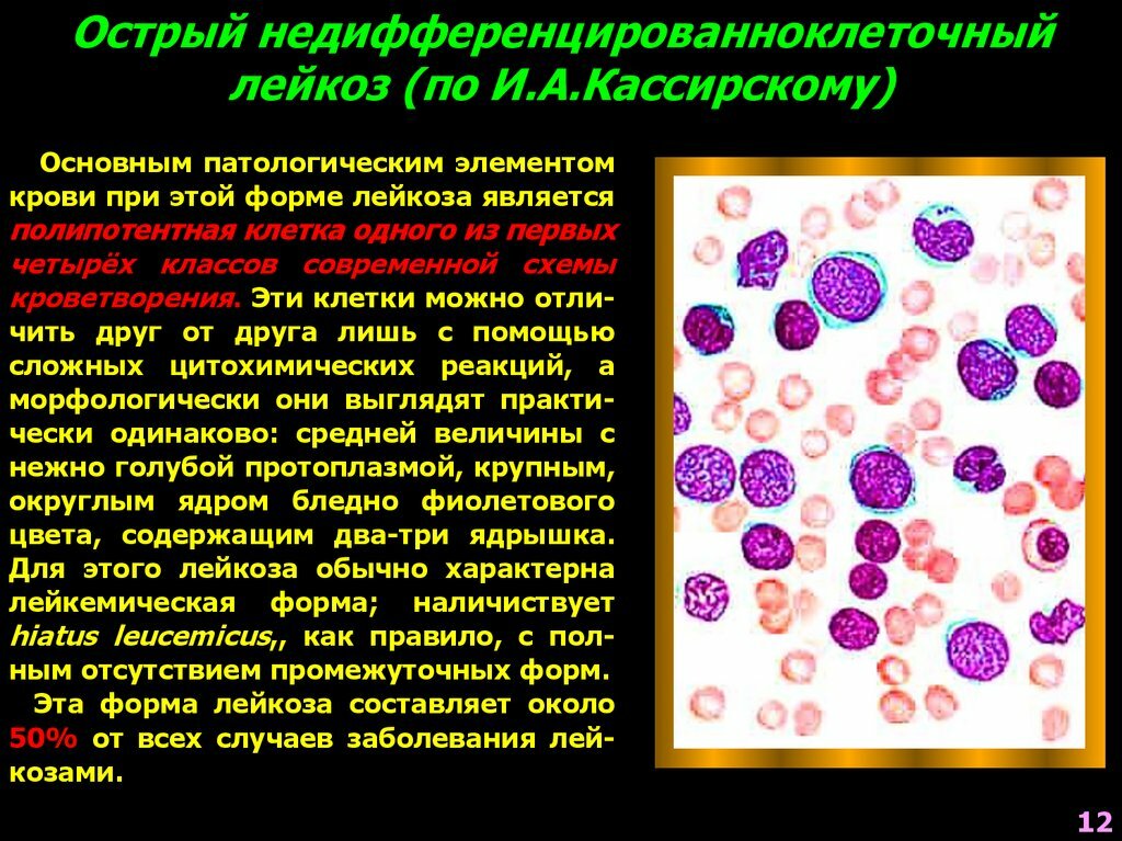 Картина крови выраженная нормохромная анемия тромбоцитопения бластов до 60 характерная для