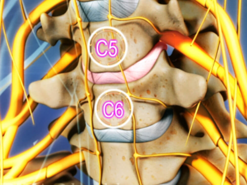 Грыжа диска с6 с7 шейного отдела