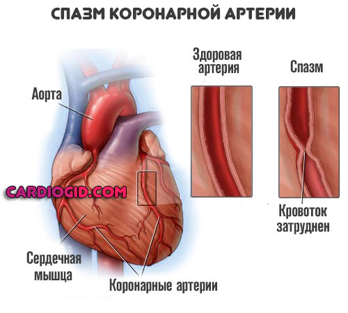 спазм-коронарной-артерии