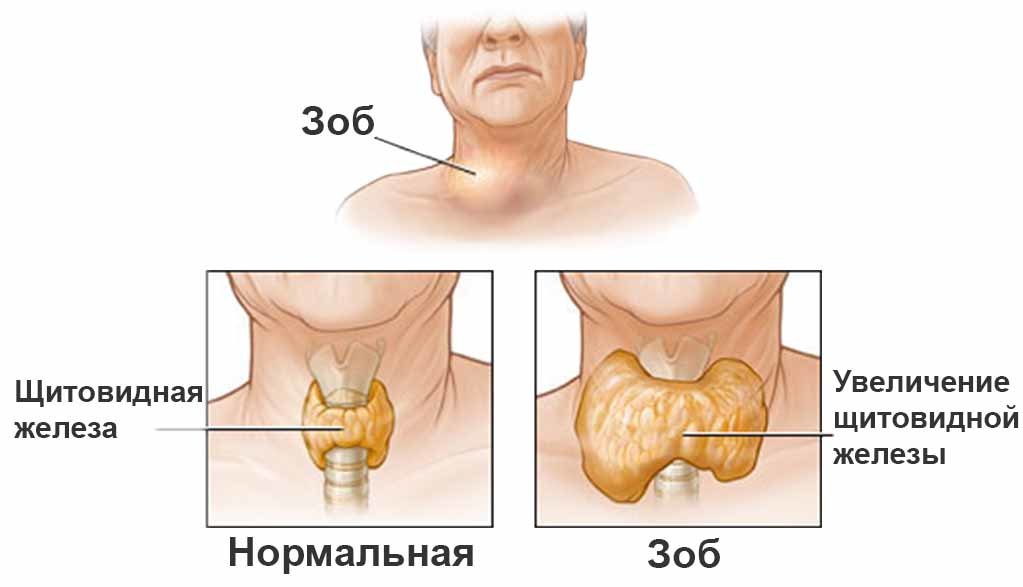 зоб щитовидки