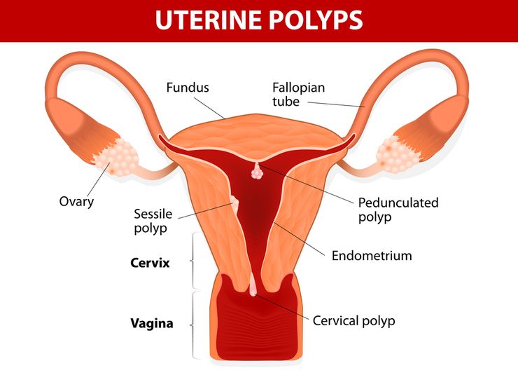плацентарный полип после родов