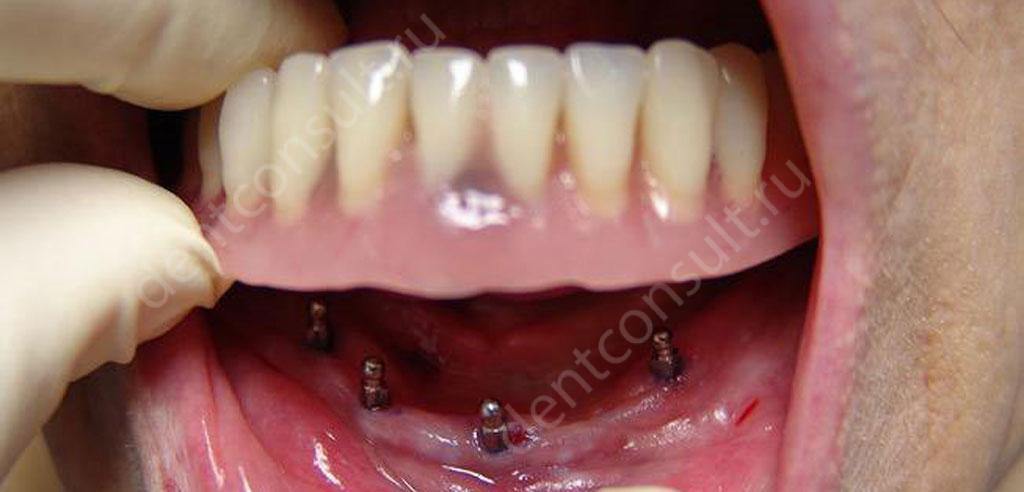 Какое протезирование зубов лучше: отзывы