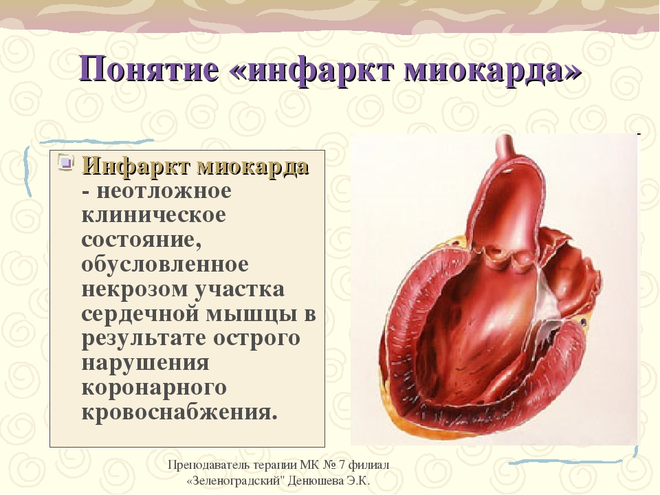 Медицинская помощь при инфаркте миокарда