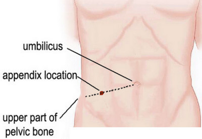 Appendix Pain Location