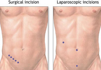 Incisions in Appendectomy