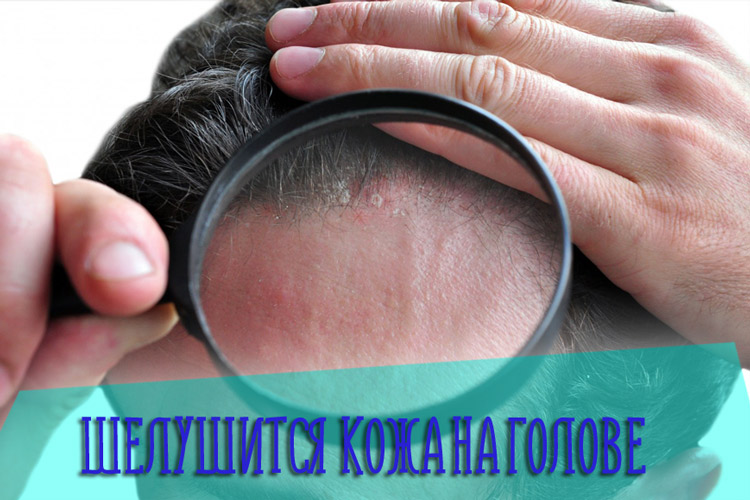Что делать если шелушится кожа на голове – причины и лечение проблемы