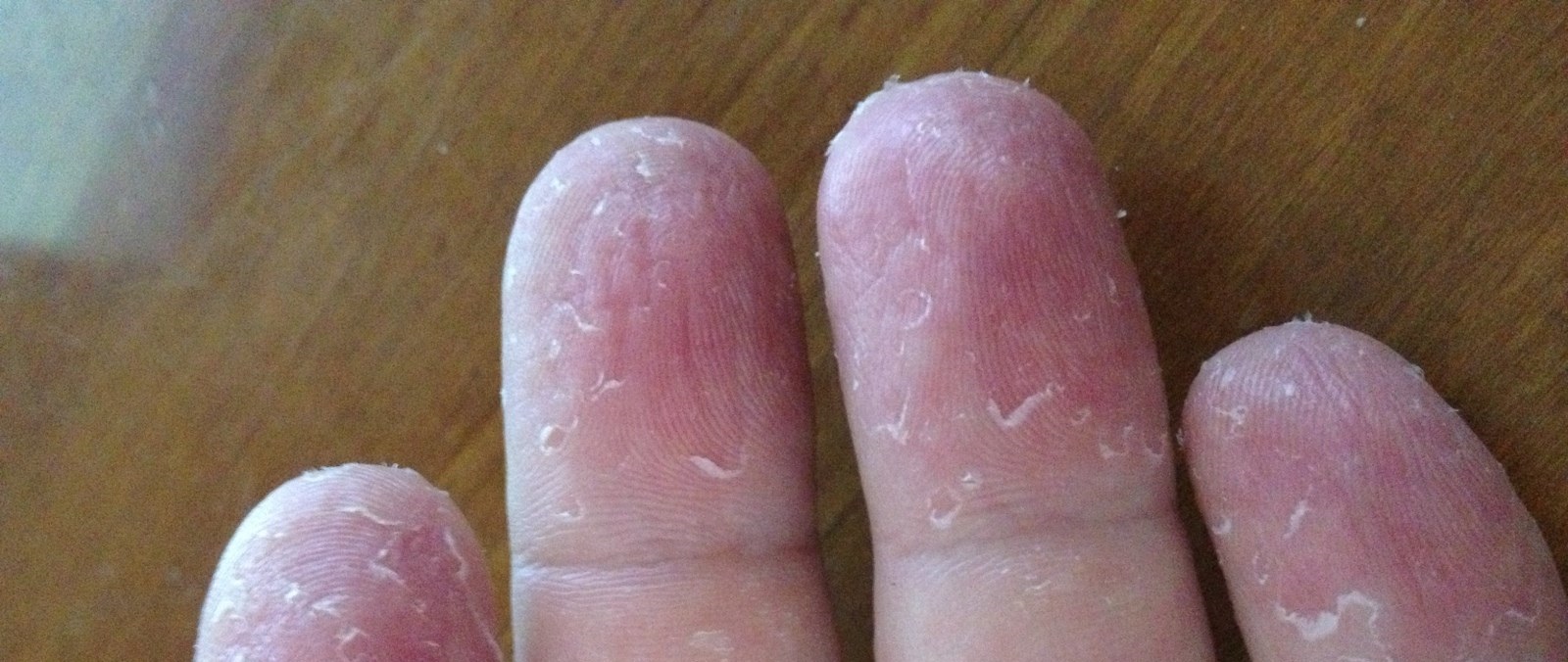 Что нужно делать если кожа на руках шелушится и облазит – советы от врачей