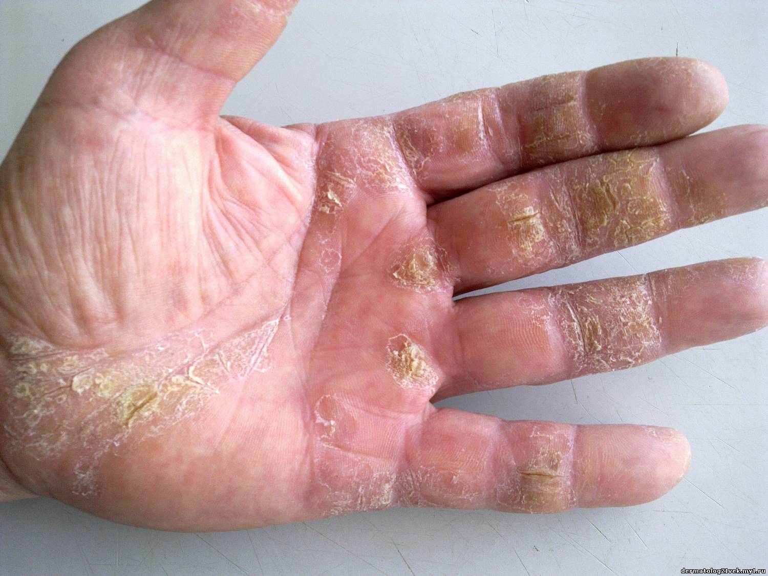 Что нужно делать если кожа на руках шелушится и облазит – советы от врачей