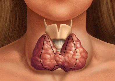 последствия после удаления щитовидной железы