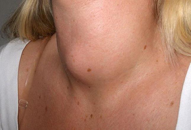Узлы на щитовидной железе чем опасны размеры