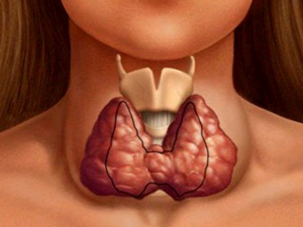 Увеличенная щитовидная железа