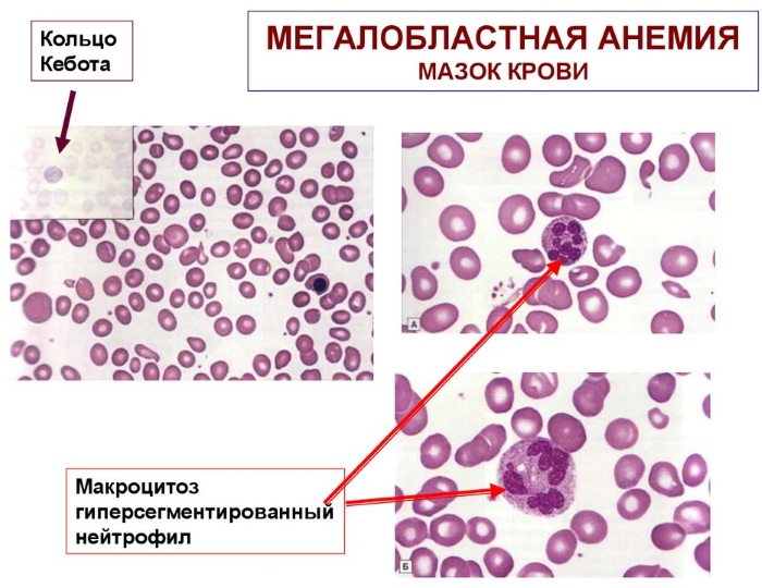 Анизоцитоз в общем анализе крови у взрослых, женщин, ребенка. Причины пониженного, повышенного