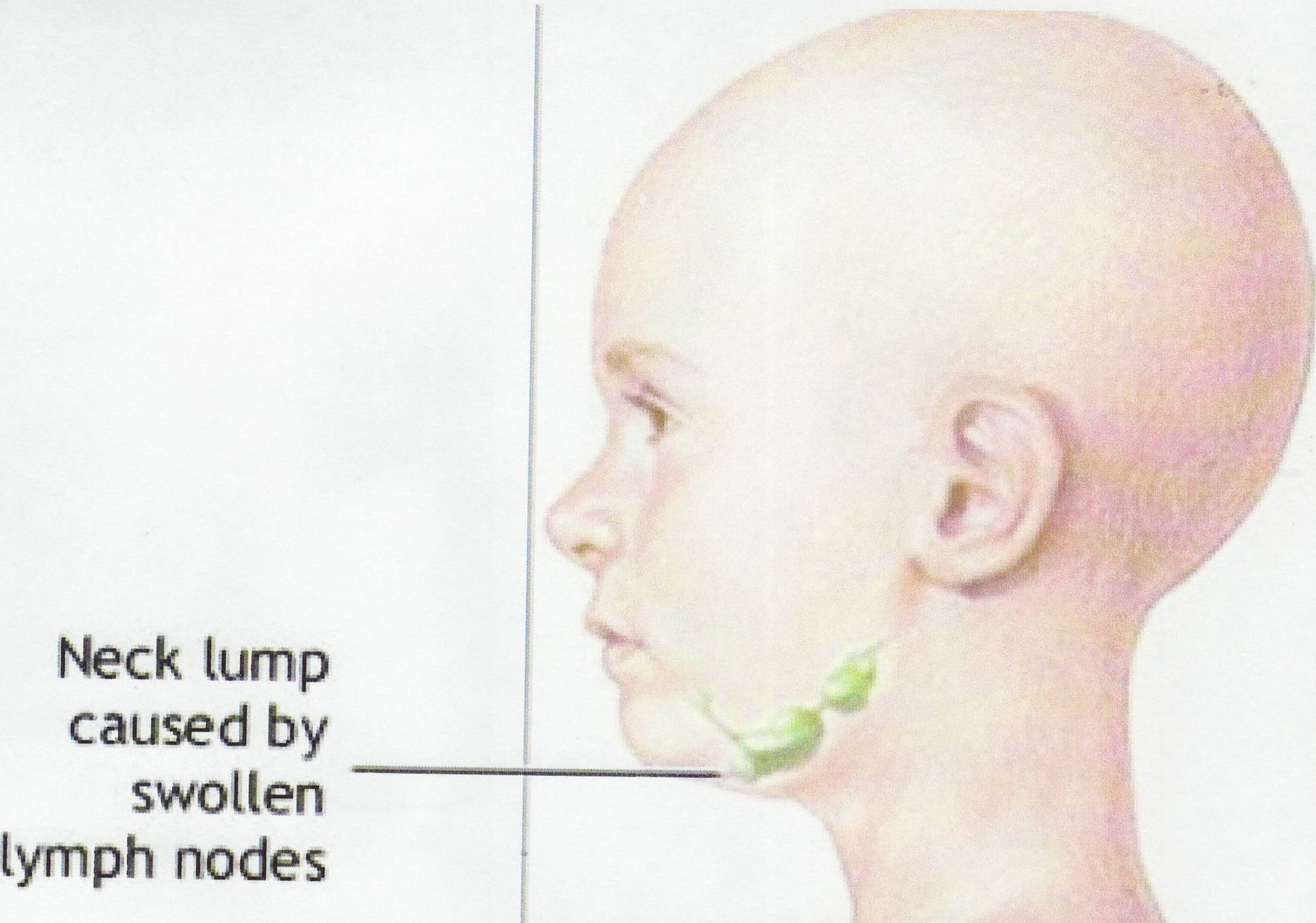 Лимфоузлы синдром. Увеличенные лимфатические узлы. Лимфатические узлы на шее увеличены. Лимфома затылочного узла.