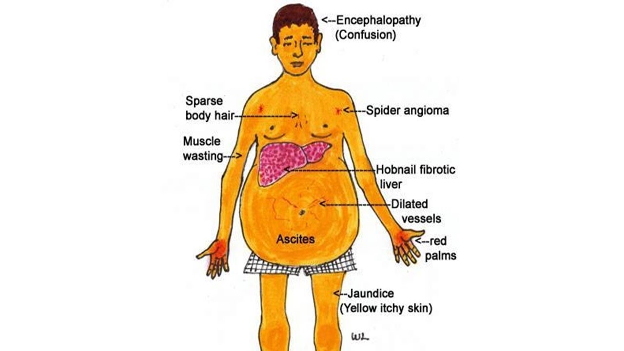 Признаки гепатита у мужчин лечение. Симптомы и стадии цирроза печени алкогольного. Опорные клинические признаки цирроза печени. Цирроз печени внешность человека.
