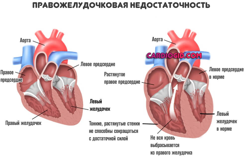 От левого предсердия к легким. Острая сердечная недостаточность правого желудочка. Недостаточность правого желудочка сердца патофизиология. Хроническая сердечная недостаточность правого желудочка. Симптомы сердечной недостаточности правый желудочек.