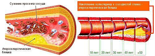 Атеросклероз сосудов