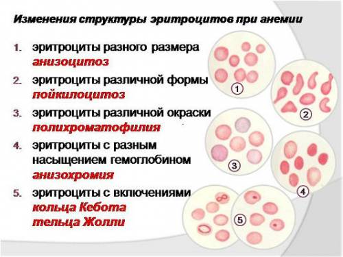 Изменения эритроцитов