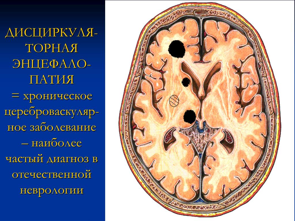 Многоочаговое поражение мозга. Дисциркуляторная энцефалопатия на кт. Энцефалопатия головного мозга что это такое. Дисциркуляторной энцефалопатии. Острая энцефалопатия головного мозга.