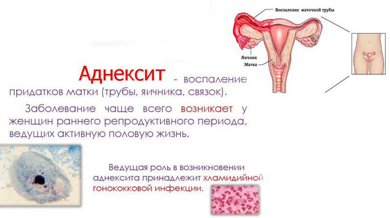 Воспаление матки. Признак застужение яичников. Воспаление придатков у женщин симптомы.