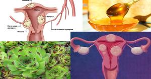 Симптомы кисты яичника у женщин