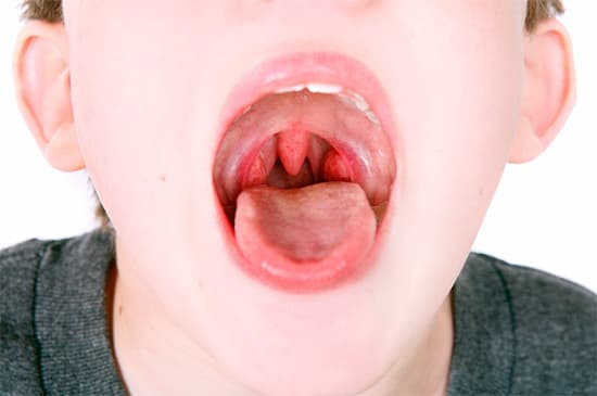 Аденоиды у детей: причины, симптомы и лечение