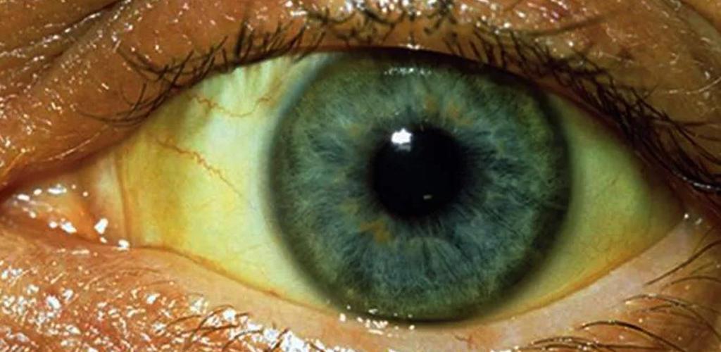Почему глаза желтоватого. Пожелтение склер гепатит. Желтоватые белки в уголках глаз. Глаза при желтухе у взрослого.
