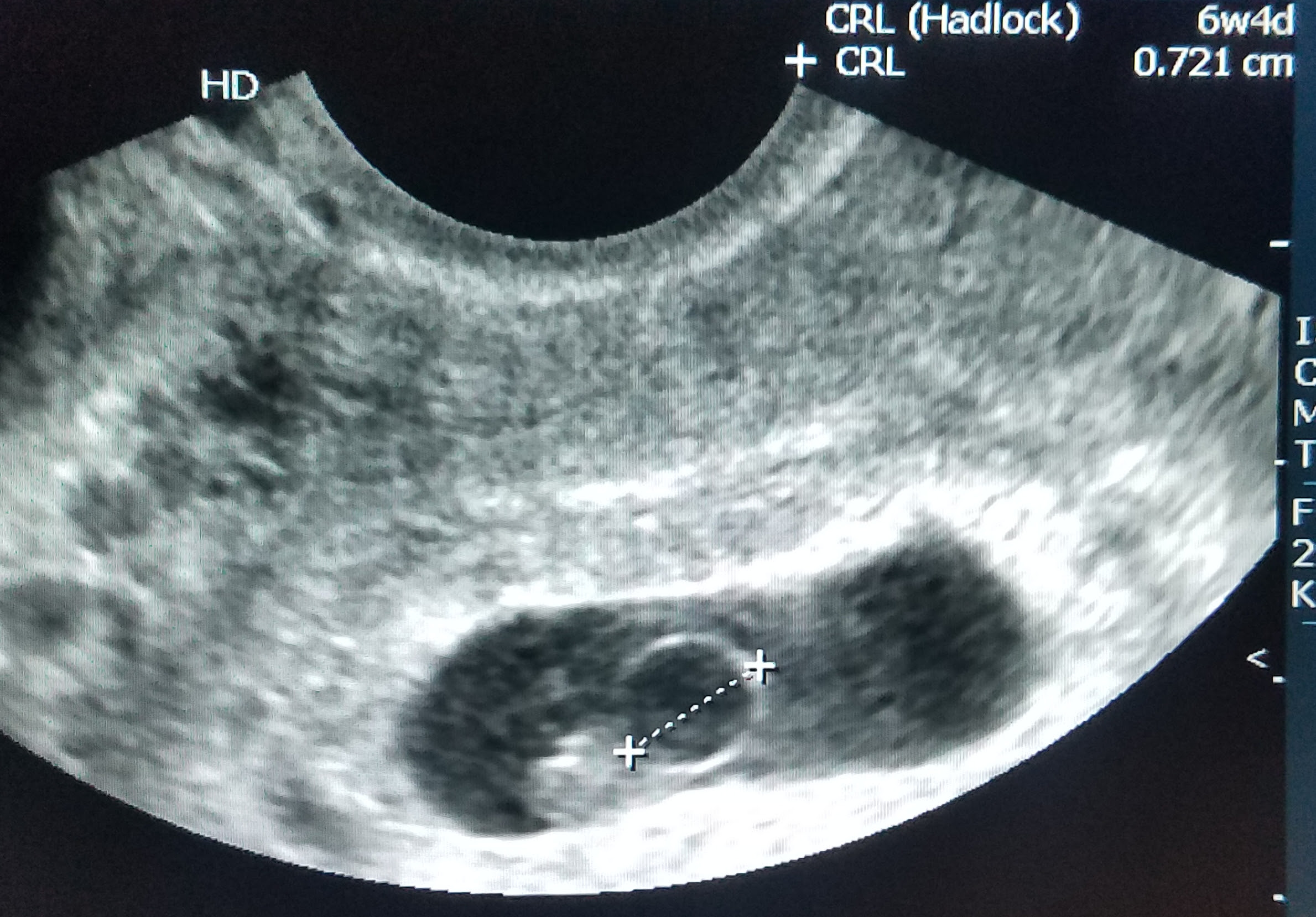 Эндометрий при переносе эмбриона