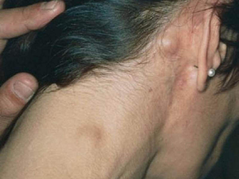 Описание внешних признаков воспаления лимфоузлов за ушами
