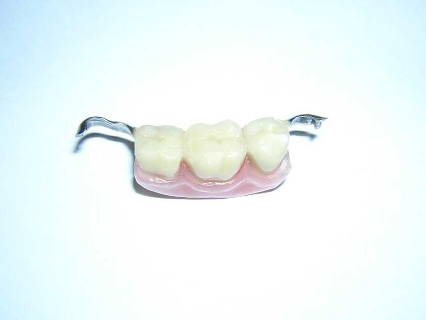 Бабочка на передний зуб. Зубной микропротез бабочка. Съемный микропротез 1 зуб. Микропротез бабочка/ иммедиат-протез. Бюгельный протез (2-3 кламмера).