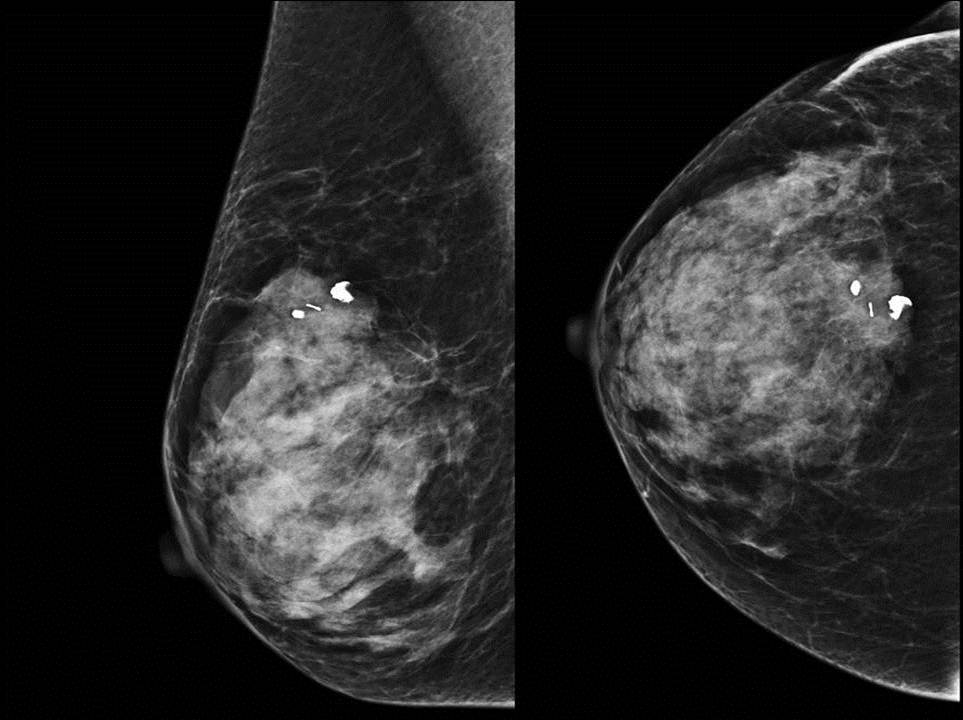 Маммография уплотнения. Фиброзно кистозная мастопатия маммограмма. Кистозная мастопатия маммография. Фиброаденома молочной железы маммография. Фиброзно кистозный мастит.