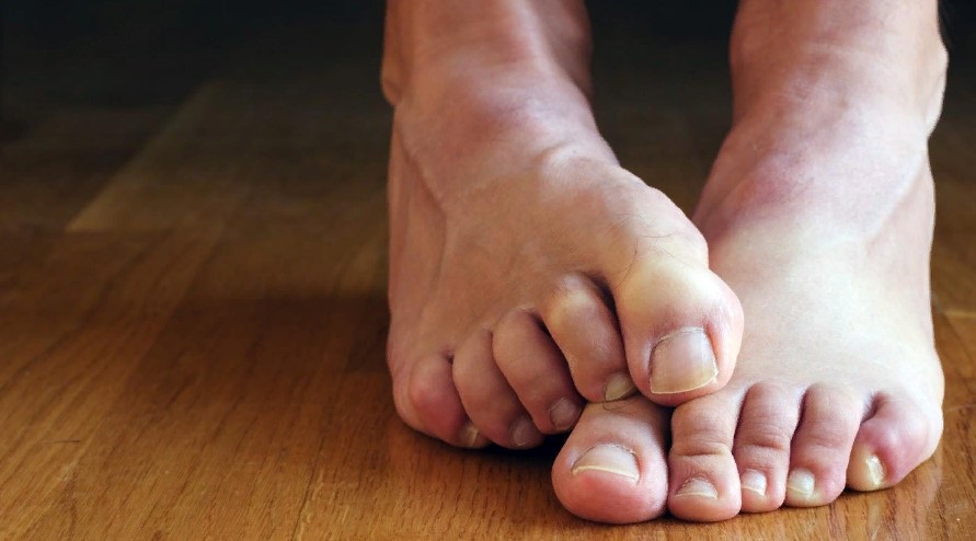 Симптомы грибка ногтей на ногах