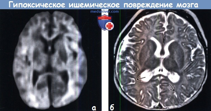 Поражение головного мозга у новорожденных. Гипоксически-ишемическое поражение головного мозга кт. Гипоксическое головного мозга мрт. Токсическое поражение головного мозга мрт. Мрт головного мозга с поражением.
