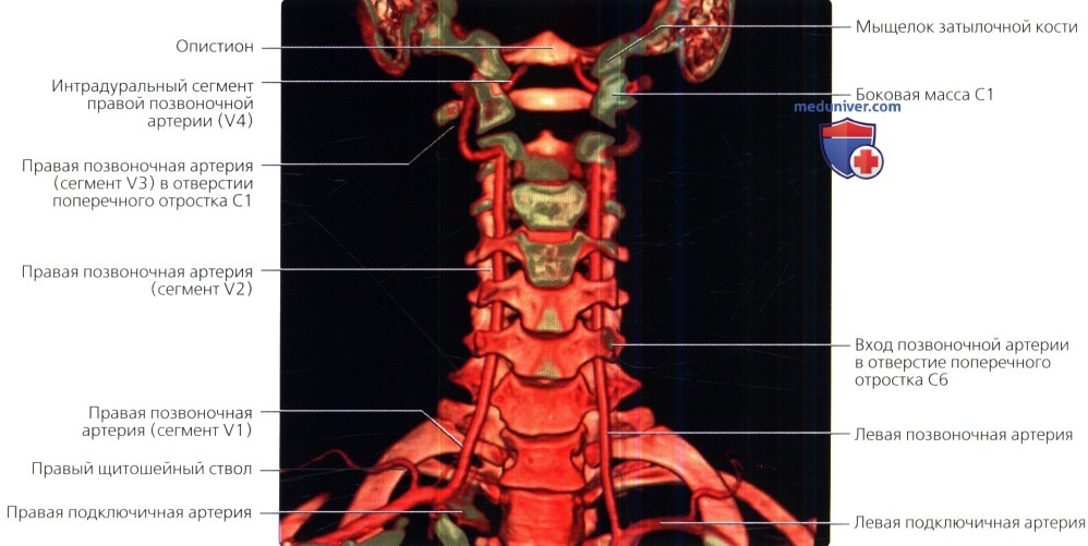 Где находятся позвоночные артерии у человека фото