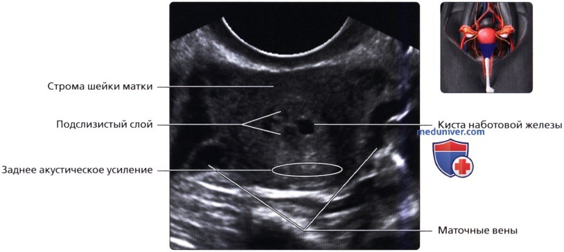 Киста в матке на узи. Киста шейки матки УЗИ протокол.