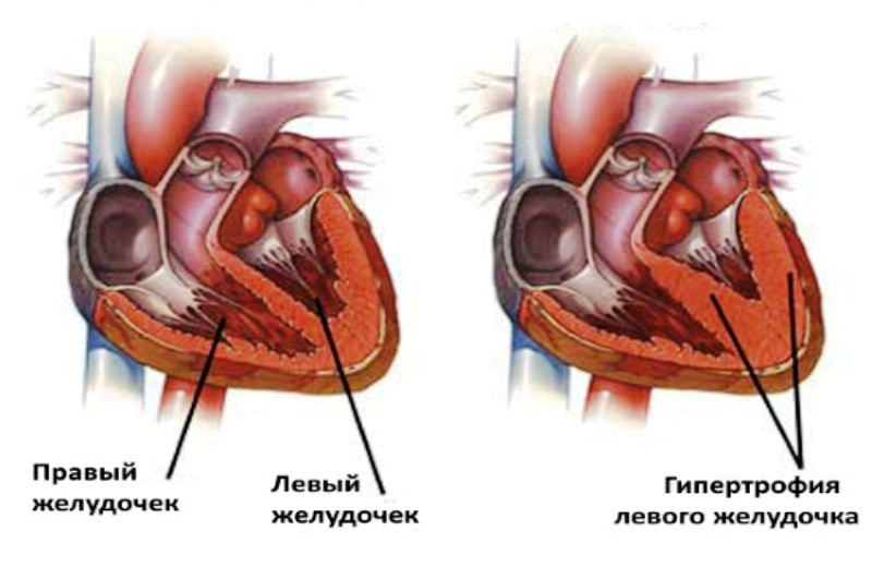 Глж сердца. Гипертрофированный миокард левого желудочка сердца. Левый желудочек сердца гипертрофирован. Гипертрофия миокарда левого желудочка осложнения. Гипертрофия левого желудочка гипертония.