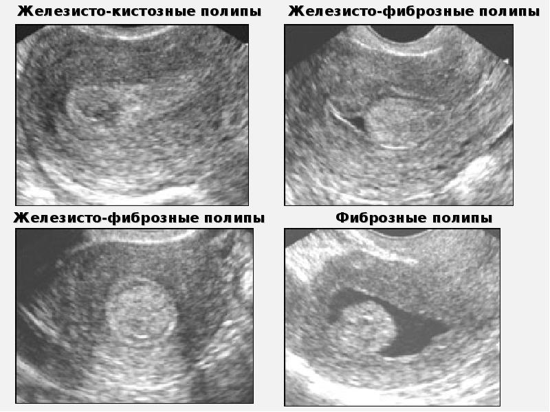 Эндометрия стенок матки. Аденоматозные полип эндометрия УЗИ. Гидросонография полипы. Железисто-фиброзный эндометриальный полип.