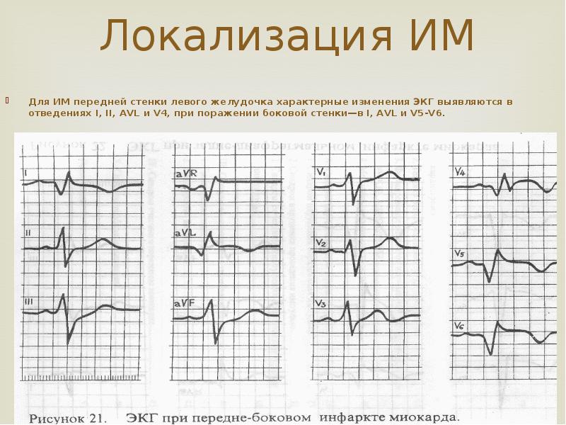 Изменения миокарда левого желудочка